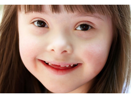 Daun sindromu diaqnozu qoyulan 100-dən çox uşağın sağlam olduğu üzə çıxıb